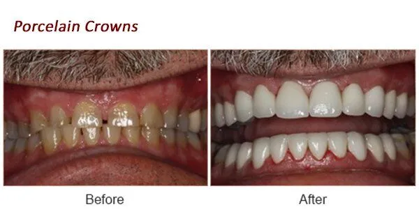 Porcelain Crowns Before and After.porcelain-crowns-before-after-1