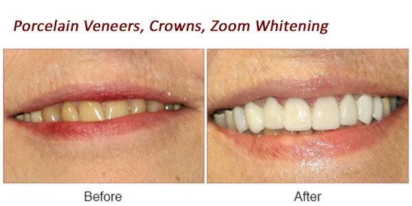 Porcelain Porcelain Veneers, Crowns, Zoom Whitening Before and After